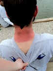 sunburned1